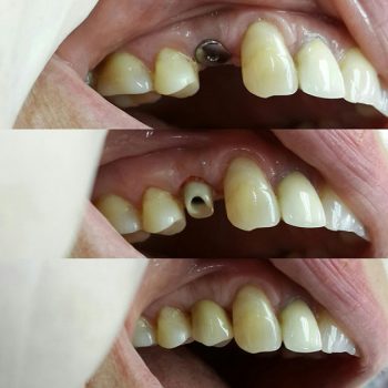 Коронка 14 зуба на импланте из диоксида циркония на циркониевом аббатменте.